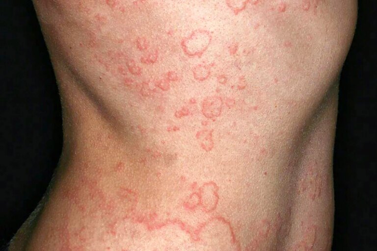 1800x1200 what is chronic spontaneous urticaria or csu features